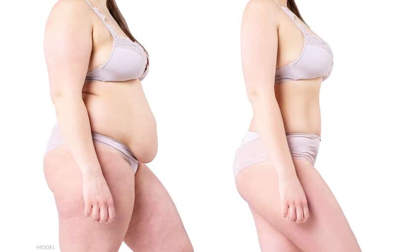Before and after photo of a woman who lost a significant amount of fat and sagging after plastic surgery