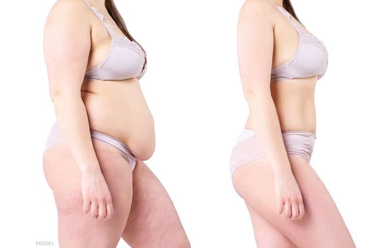 Tummy Tuck Cosmetic Surgery, Fat Loss Procedure, Liposuction, Removal  Excess Fat