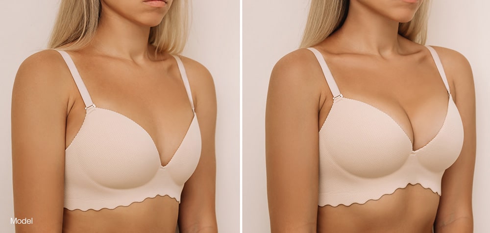 Woman with two different breast profile
